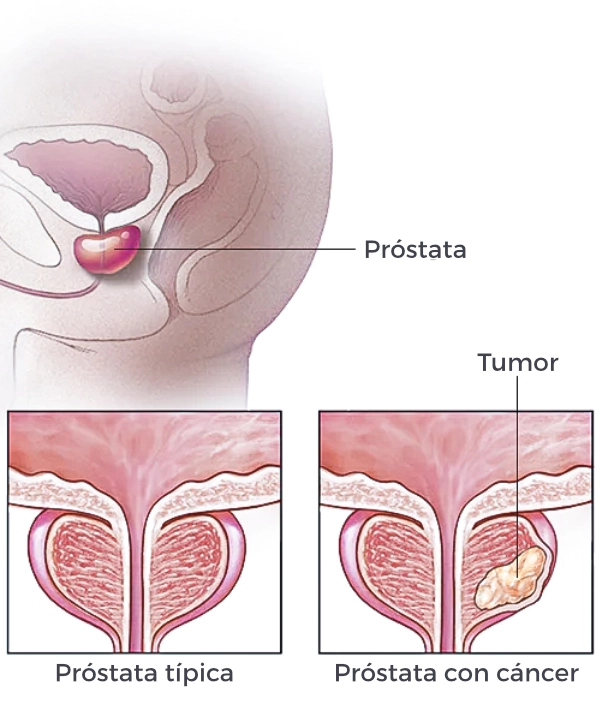 cáncer de próstata